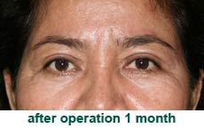 plastic-surgery-blepharoplasty